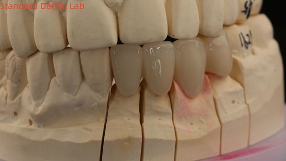 কেনা সলিড ডেন্টাল ল্যাব ক্রাউন 3D প্রো উচ্চ স্বচ্ছতা পূর্ণ জিরকোনিয়া ক্রাউন ভিটা ছায়া কাস্টমাইজড অনলাইন উত্পাদন