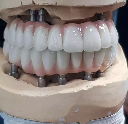 প্রাকৃতিক চেহারার দাঁতের জন্য সংরক্ষিত সুনির্দিষ্টভাবে তৈরি জিরকোনিয়া ইমপ্লান্ট স্ক্রু সিমেন্ট