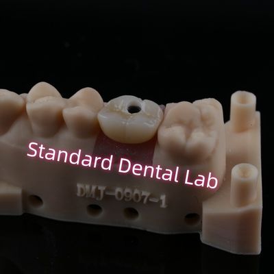 কাস্টম Abutment ইমপ্লান্ট ক্রাউন পূর্ণ কনট্যুর Zirconia স্ক্রু সংরক্ষিত
