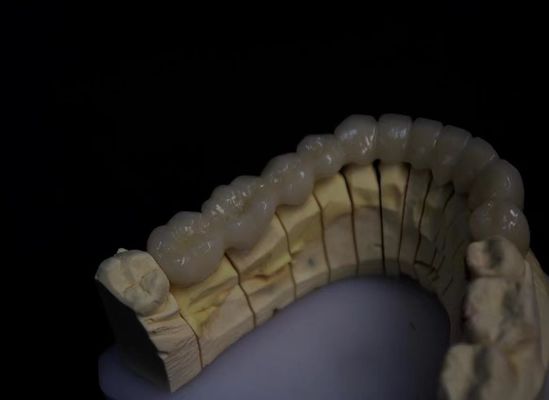 স্তরযুক্ত পোরসেলান ফিউজড জিরকোনিয়া