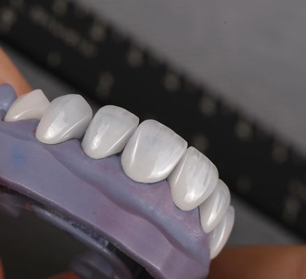 প্রাকৃতিক চেহারা Emax Veneers Crown Biocompatibility ন্যূনতম প্রস্তুতির সাথে সাদা রঙ